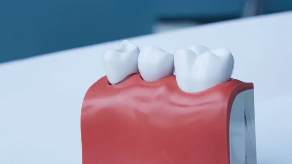 Dentists tooth plastic model with screw implant for teaching, learning and patients in dental office showing teeth and gums. — Stock Photo, Image