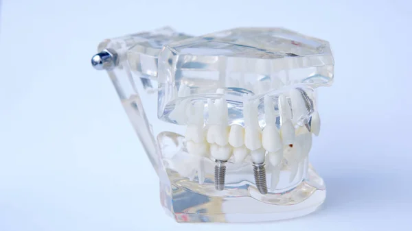 Dentisti modello in plastica dentale con impianto a vite per l'insegnamento, l'apprendimento e pazienti in studio dentistico che mostrano denti e gengive . — Foto Stock