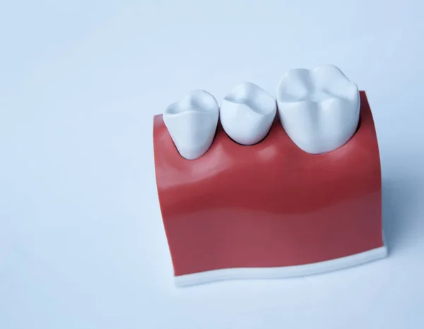 This model shows that teeth have been capped and the stainless pin in the gums. — Stock Photo, Image