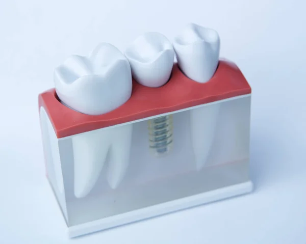 Dentyści ząb plastikowy model z implantu śruby na nauczanie, uczenie się i pacjentów w gabinecie stomatologicznym, pokazując zęby i dziąsła. — Zdjęcie stockowe