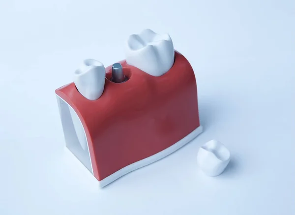 Close up de um modelo de implante dentário . — Fotografia de Stock