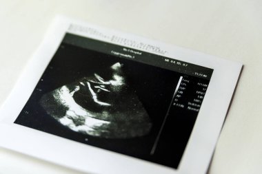 Sağlık tehlikesi olan kalp ultrasonu resmi kağıda basıldı.