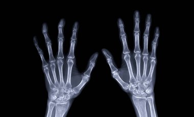 Tanısal romatizma için her iki elin de Xray görüntüsü siyah arkaplan üzerinde izole