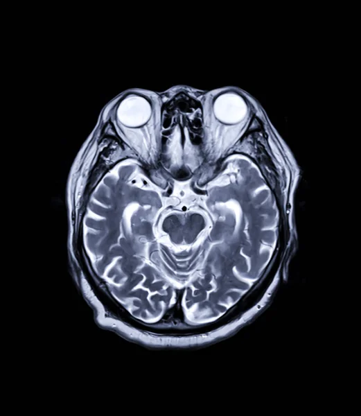 Mri脳軸T2技術は 発生および構造異常感染症などの脳のさまざまな状態を検出するための技術です — ストック写真