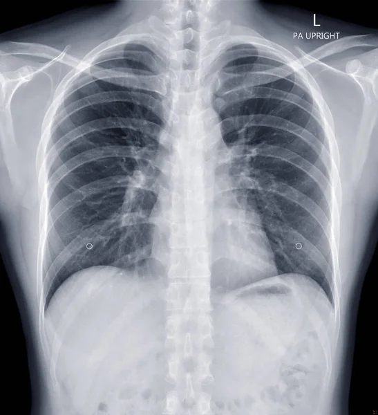 Chest Ray Human Chest Diagnosis Tuberculosis Check Concept — Stock Photo, Image