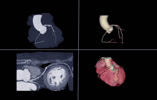 CTA Coronary artery 3D rendering image or coronary tree with Curve MPR of LAD view for diagnosis of vessel coronary artery stenosis .