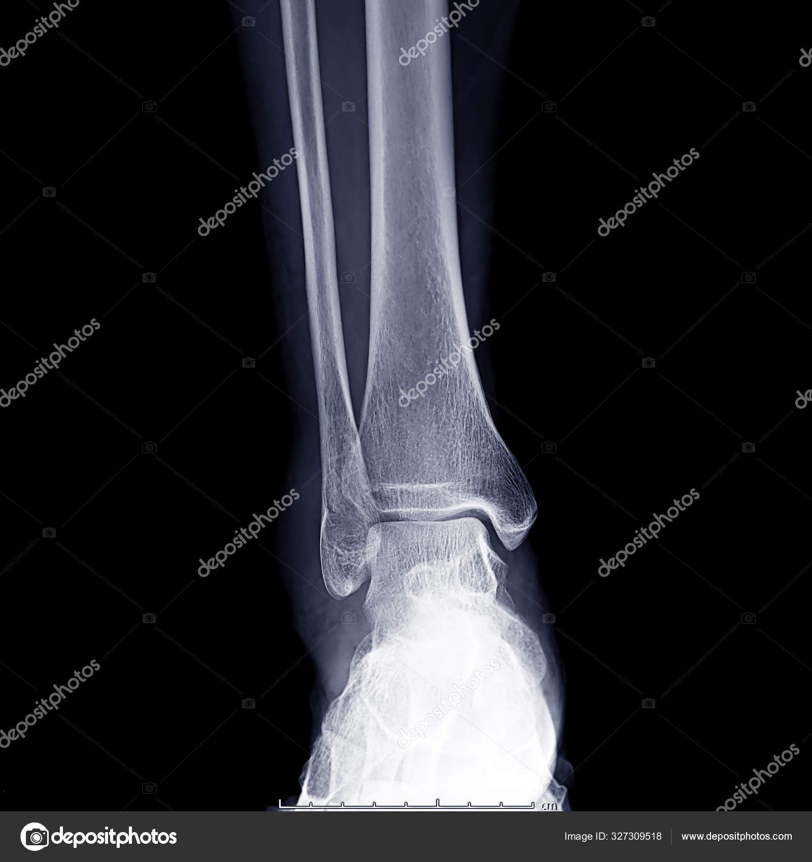 Raio-x da coluna cervical bonitinho : r/Radiology, image size:1600x1700
