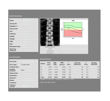 Dexa densitometri raporu Osteoporosis için mevcut bel omurga taraması, sıkça osteoporoz öncülü.