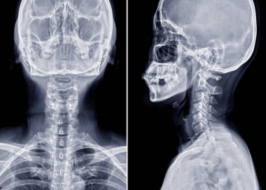 Servikal omurga Ap 'ının röntgen filmi veya röntgen görüntüsü ve omurgalar arası teşhis diski fıtığı için Lateral görüş