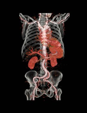  Cta abdominal aort 3d görüntü şeffaf kemik ile aort diseksiyonu gösteriyor.