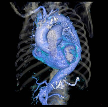 Diyagnotik abdominal aort anevrizması ya da aaa ve aort diseksiyonu için Cta torasik aort 3d görüntüleme