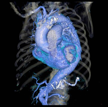 CTA thoracic aorta  3D rendering image for  diagnotic abdominal aortic aneurysm or AAA and aortic dissection clipart