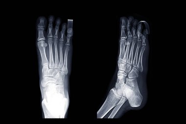 X-ray Sağ ayak görüntüsü Ap, eğik ve yanal 