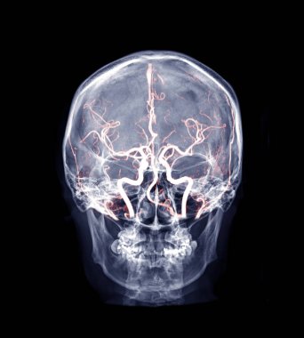  İnsan kafatasının kafatası x-ray görüntüsü Mra Beyin görüntüsü kafatasındaki beyin arterini gösteriyor.