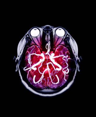 Eksen görünümünde MRI ve Mra Beyin karışımı.
