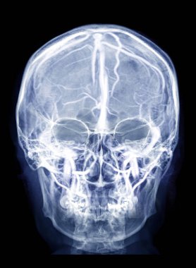 İnsan kafatasının kafatası x-ray görüntüsü Ap görünümü ile Bay Beyin görüntüsü kafatasında beynin venöz sinüslerini gösteriyor.