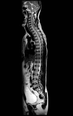 Tüm omurga T2W sagittal düzlemi MRI tanısal omurilik sıkıştırması için.
