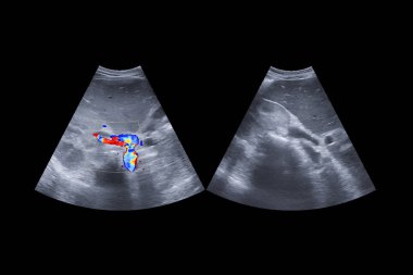 Karnın üst ultrasonunda hepatobilier sistem anatomik ve karaciğer mesanesi ve hepatik hücre kanserini taramak için safra kesesi görülüyor. Yol kırpılıyor