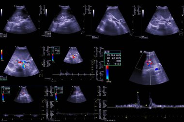  Ultrason üst karın röntgeni hepatobilier sistem anatomik ve hepatik hücre kanserinin taranması için karaciğer ve safra kesesi olduğunu gösteriyor. Yol kırpılıyor