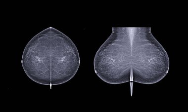 Basic position X-ray Digital Mammogram both side name is CC view and MLO . mammography or breast scan for Breast cancer. clipart