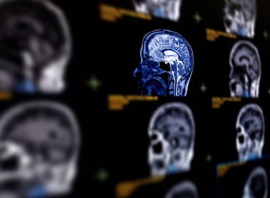 Beyinde kist, tümör, kanama, şişkinlik, gelişimsel ve yapısal anormallikler veya enfeksiyonlar gibi çeşitli durumları tespit etmek için MR beyin sagittal düzleminin seçici odak noktası .