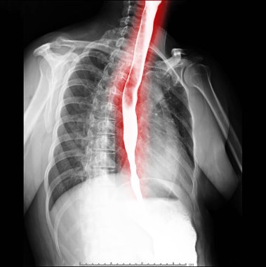 esophagram