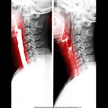 esophagram