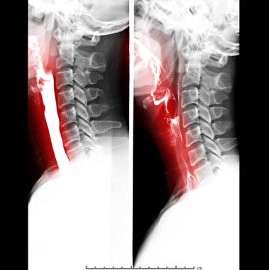 Esophagram clipart