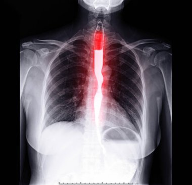 esophagram