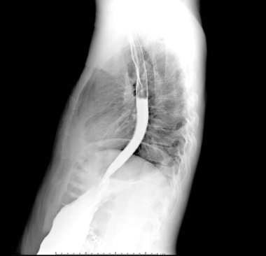 esophagram