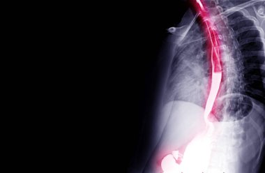 Esophagram veya Baryum kırlangıcı tıbbi konsept için eğimli görünüm.
