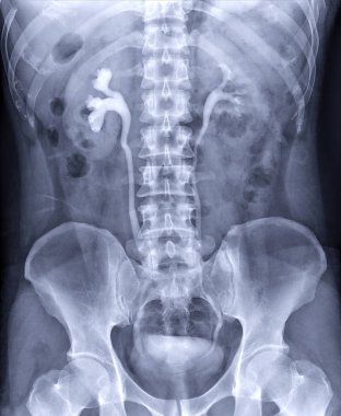  İntravenöz piyelogram ya da I.V.P, enjeksiyondan 10 dakika sonra idrar yollarının X-ray muayenesidir..