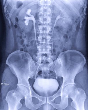  Intravenöz piyelogram veya I.V.P, 25 dakikalık kontrasttan sonra idrar yolu röntgenidir..