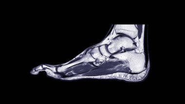 MRI FOOT Sagittal T2  for diagnostic tendon injury. clipart