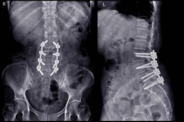 Lumosacral omurga veya L-S omurga Ap ve yan Post operatif Lumbar Plates röntgen görüntüsü ve vida.