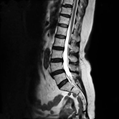 Sagittal düzlem T2 'de omurga ya da lambosakral omurga MRI ya da L-S tanısı için T2 tekniği.