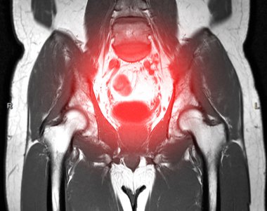 MRI Lower abdomen Coronal plane T2 Technique for finding myoma uteri. clipart