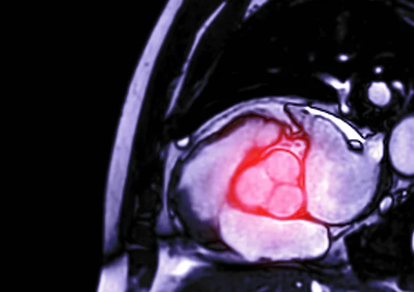 MRI heart or Cardiac MRI ( magnetic resonance imaging ) of heart  showing aortic valve for diagnosis heart disease.