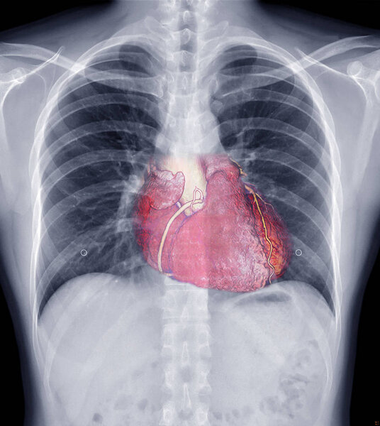 Mix Chest X-ray and 3D CTA Coronary arery Image showing heart inside the chest . check up concept.