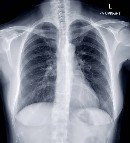 Göğüs röntgeni veya insan göğsünün röntgeni. — Stok fotoğraf