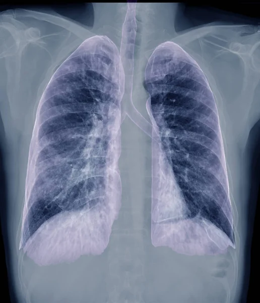 Chest X-ray or X-Ray Image Of Human Chest with 3D rendering of lung for diagnosis tuberculosis . check up concept.