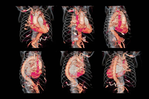 Kolekce Cta Hrudní Aorty Vykreslování Obraz Pro Diagnózu Abdominální Aortální — Stock fotografie