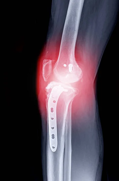 Imagen de rayos X de la rodilla derecha AP view . — Foto de Stock