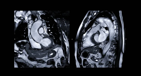 心脏的Mri心脏或心脏Mri 磁共振成像 比较Rvot和Lvot对心脏病的诊断 — 图库照片