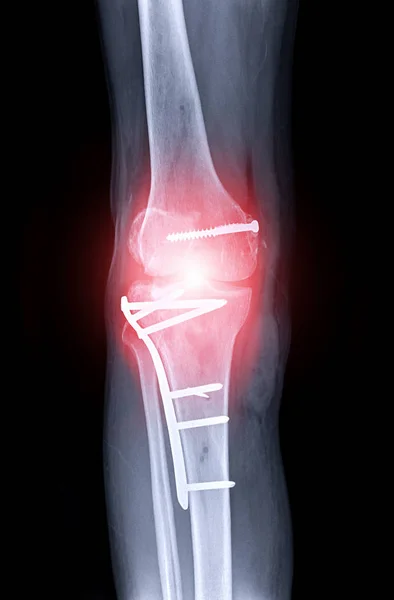 Immagine a raggi x del ginocchio destro vista AP . — Foto Stock