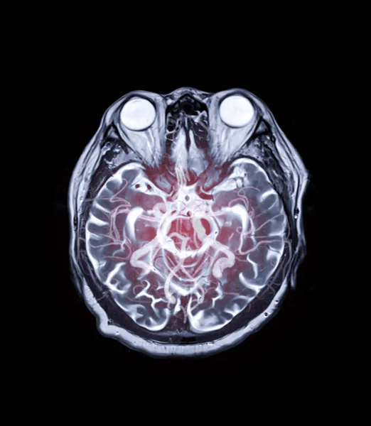 Mri Hersenen Axiale Techniek Met Mra Brain Mix Beeld Voor — Stockfoto