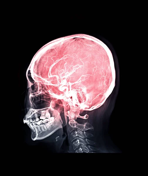 Рентгенівське Зображення Черепа Людського Черепа Бічна Суміш Mrv Зображення Мозку — стокове фото