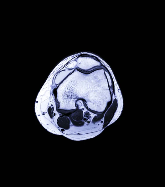 MRI Knee joint  3view — ストック写真