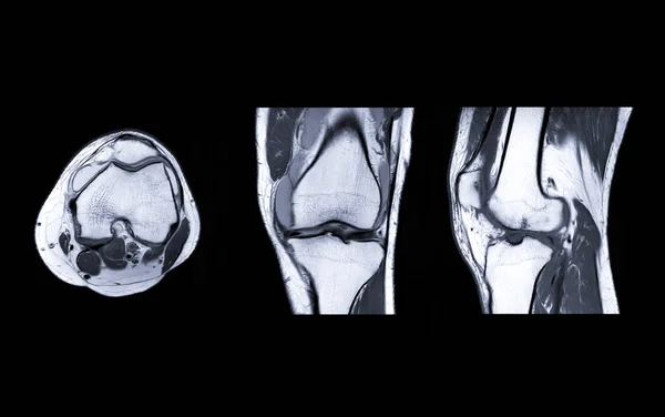 MRI Knee joint  3view — ストック写真