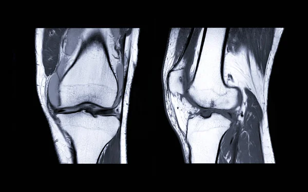 MRI Колінний суглоб 3view — стокове фото